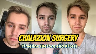 Chalazion Surgery Healing Timeline before and after [upl. by Ylime]