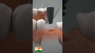 DENTAL IMPLANT 🦷dentist trending viralvideo dentalclinic [upl. by Alain703]