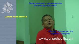 The numbness in lower leg went away lumbar spinal stenosis is cured by acupuncture 【Dr Zhiye Liu】 [upl. by Allemat]