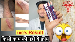 Mederma cream  Mederma advanced scar gel review  Mederma cream ke fayde  किसी काम की नही क्रीम 😱 [upl. by Orola]