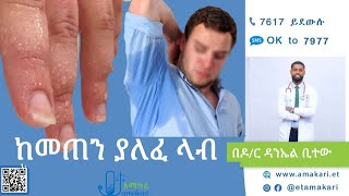 ከመጠን ያለፈ ላብ መንስኤዎች፤ ምልክቶች፣ ምርመራ እና ህክምና [upl. by Elokin612]