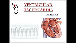 Ventricular Tachycardia and its differentiation from SVT with Aberrancy  Dr Akif Baig [upl. by Bella810]