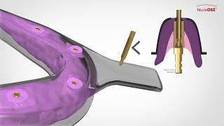 NucleOSS T6 Implant  Vidalı Çözümler  Açık Kaşık Ölçü Parçaları  Kullanım TR [upl. by Quinton]