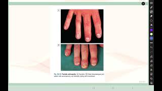 Rheumatology L5 Spondyloarthropathies p33 Psoriatic arthritis [upl. by Sussi]