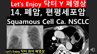 14폐암편평상피세포암CTNSCLC폐암진단lung cancerSCC폐암사진폐결절DrYchestradiology닥터와이폐영상obstructive pneumonitis [upl. by Ennair]