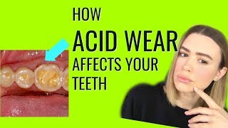 PROTECT YOUR TEETH FROM ACID WEAR [upl. by Monda887]