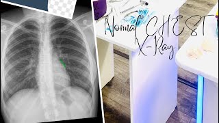 Chest Xray normal view what is chest Xray🤔 [upl. by Naneek]