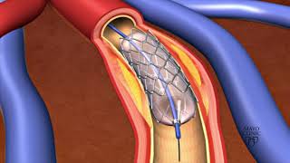 Animation  Coronary stent placement [upl. by Odine]