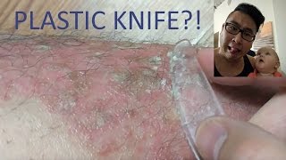 PSORIASIS MAINTENANCE WITH A PLASTIC KNIFE [upl. by Tawnya]