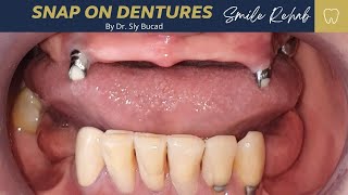 SNAP ON DENTURES [upl. by Vinson]