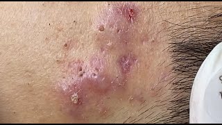 Hematoma Inflammation Acne HoangMySpa87 [upl. by Ellett]