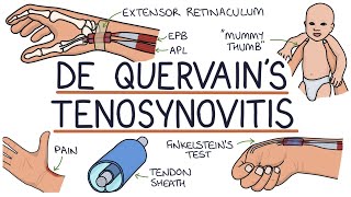 Understanding De Quervain’s Tenosynovitis Mummy Thumb [upl. by Jerold]