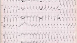 Advanced ECG exam Dr Sherif Altoukhy [upl. by Nwahsem]