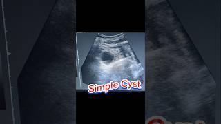 Simple Cyst  Ovary Cyst  Adnexa Cyst  haemorrhagic Cyst on Ultrasound [upl. by Tiga795]