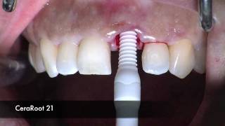 Extraction of central incisor and immediate placement of a CeraRoot 21 zirconia implant [upl. by Beaufert]