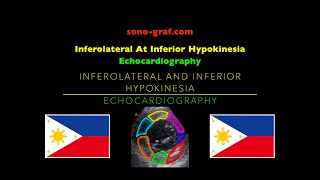 Echocardiography  Inferolateral At Inferior Hypokinesia [upl. by Laurella]