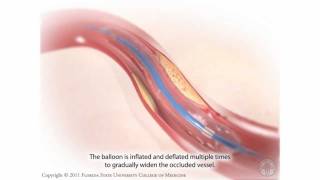 Percutaneous Coronary Intervention Coronary Angioplasty [upl. by Aisat700]