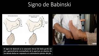 Signo de Babinski [upl. by Rasmussen996]