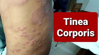 Tinea Corporis  WideSpread [upl. by Anuahsed]