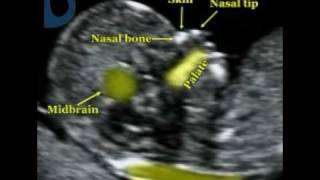 Fetal Medicine Foundation  Fetal profile [upl. by Ennovehc883]