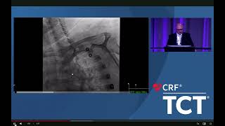 Complex Carotid Stent Procedure with Bovine Aortic Arch solved via a Transradial Approach [upl. by Nefen]