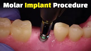 Step by Step Dental Implant Procedure  Back Molar [upl. by Peppy]