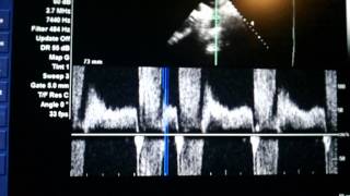 Ecocardiograma  Insuficiência aórtica importante Echocardiogram  severe aortic insufficiency [upl. by Ocicnarf]