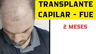 TRANSPLANTE CAPILAR  FUE 2 MESES [upl. by Gris]