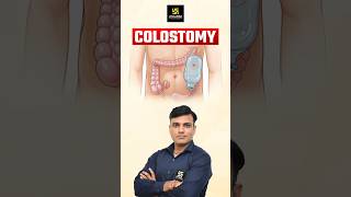 Colostomy Surgical Opening shorts utkarshnursing shailendrasir [upl. by Iams]