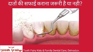 दातों किं साफाई करवाना जरूरी है या नही  Dental scaling necessary or not [upl. by Suidualc]