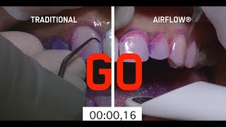 Abrasive teeth cleaning method vs AIRFLOW method [upl. by Eecram256]