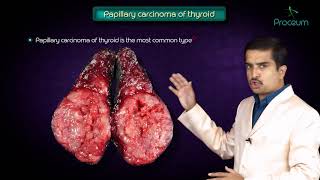 Thyroid neoplasms part 1  Papillary carcinoma of thyroid   Endocrine pathology [upl. by Adnorrehs]