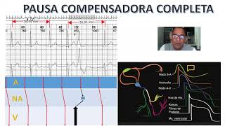 🅿🅰🆄🆂🅰 compensadora 🅲🅾🅼🅿🅻🅴🆃🅰 en extrasístole Ventricular Análisis del Ekg mecanismo y Escaleligrama [upl. by Sumedocin]