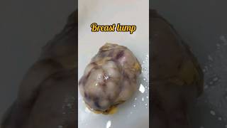 Breast lump excision biopsy for histopathology😨 breastcancer breastdisease breastfeeding lump [upl. by Sleinad442]