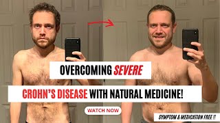 Reversing Severe Crohns Disease with Natural Medicine Watch How [upl. by Trisha]