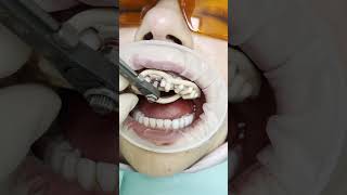 Dental implant in Prague shorts dentist dental implant veneers short [upl. by Ahsienak]