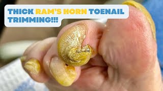 Thick RAM’S HORN TOENAIL Trimming [upl. by Wei]