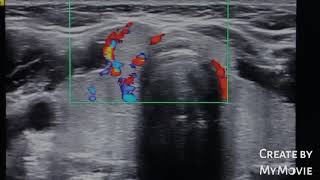 Exophytic thyroid nodule with microcalcifications  ultrasound [upl. by Emery]