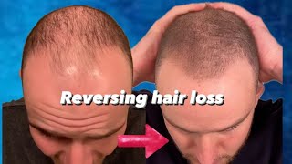 FINASTERIDE  MINOXIDIL IS IT SAFE Reversing hair loss EP 3 pt 2 with CEO Dr Simon Pinstone [upl. by Aled]