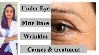 Fine lines  wrinkles under eye causes amp treatment Prevention  Dr Aanchal Panth [upl. by Yesllek]