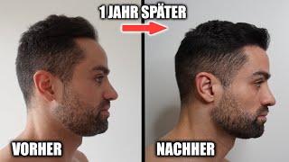 Meine HAARTRANSPLANTATION  1 Jahr danach ZUFRIEDEN [upl. by Akirej]