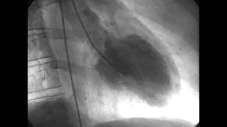 Procedural Coronary Angiography of Coronary Artery Thrombus Aspiration Followed by Bolus Intracorona [upl. by Evilo]