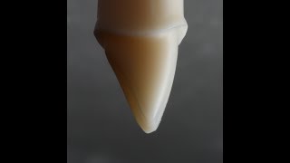 All Ceramic Crown Preparation for Emax and Zirconia [upl. by Ogg489]