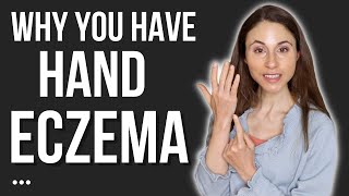 THIS IS WHY YOU HAVE HAND ECZEMA 🖐 DERMATOLOGIST DrDrayzday [upl. by Darnall]