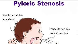 Pyloric Stenosis [upl. by Loresz16]