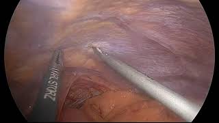 Laparoscopic Harvest of Omental Flap [upl. by Nauqel]