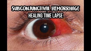 14 Days Healing Time Lapse Broken Blood Vessel in Eye Subconjunctival Hemorrhage [upl. by Neerak]