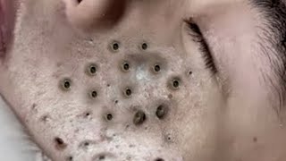 Big Cystic Acne Blackheads Extraction Blackheads amp Milia Whiteheads Removal Pimple Popping  6608 [upl. by Anatnom]