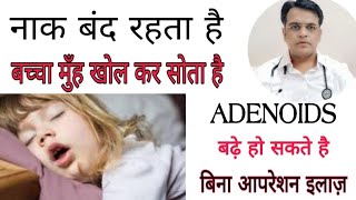 Treatment of enlarged adenoids । अडेनोइड का बिना आपरेशन इलाज़ । What is adenoids । [upl. by Herbst]