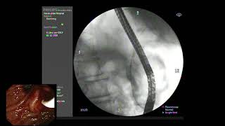 ERCP  Juxtaampullary duodenal diverticulum cannulationJAD [upl. by Acceb918]